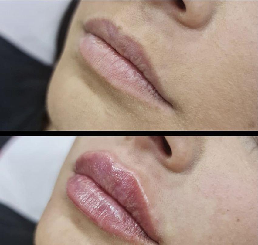 Lip Filler Before and After